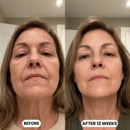 Customer before and after 12 weeks of silkcolla collagen mask
