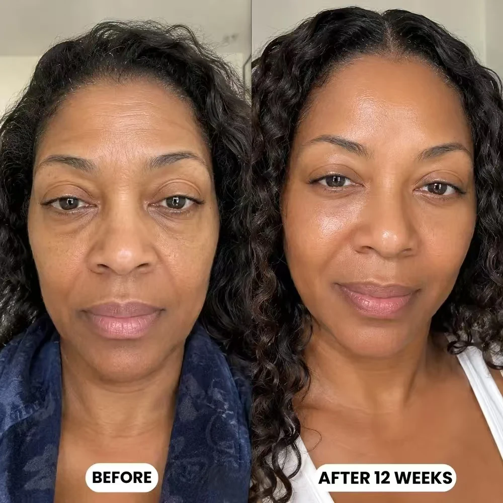 Customer before and after 12 weeks of silkcolla collagen mask