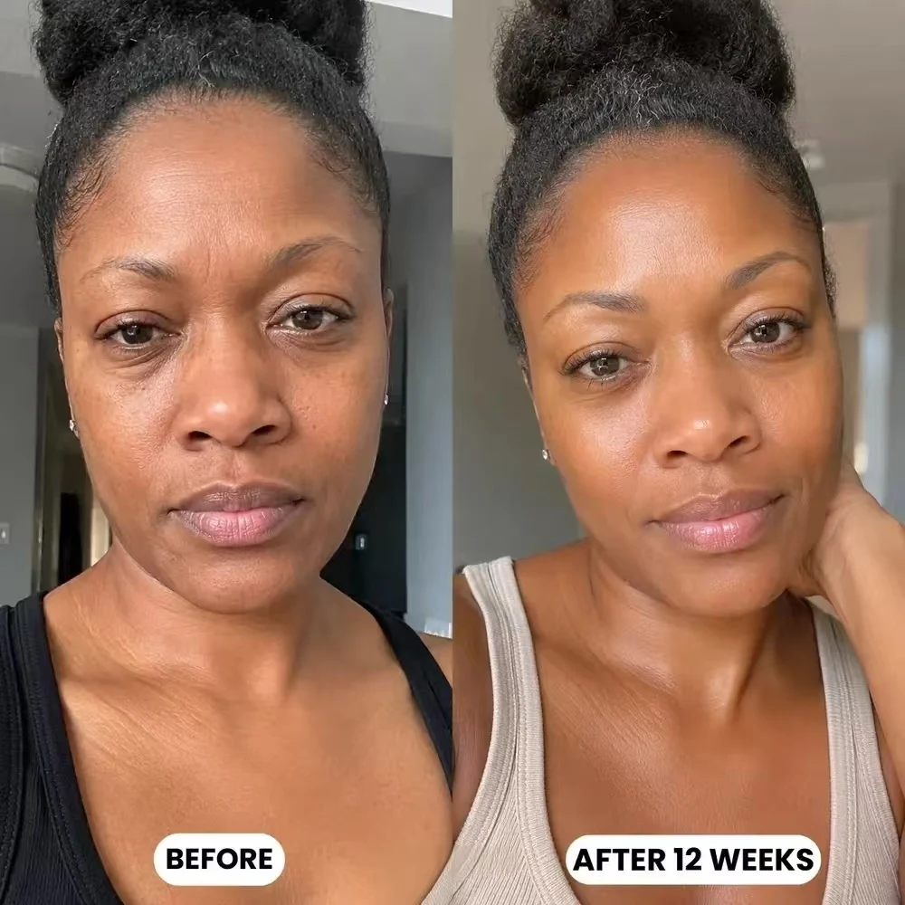 Customer before and after 12 weeks of silkcolla collagen mask